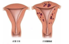经期3个表现警惕子宫腺肌症